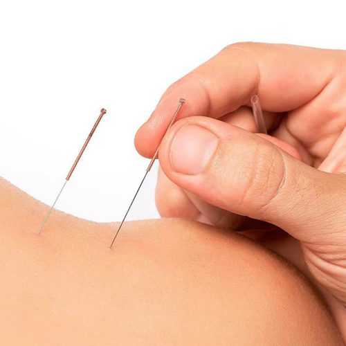 Dry needling at Biddenden Chiropractic. We offer a range of treatments for back, shoulder & neck pain.